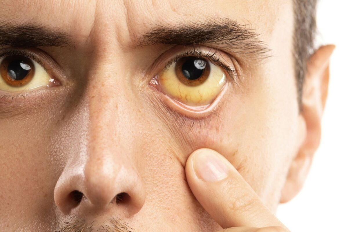 Sindrome di Gilbert — infografica